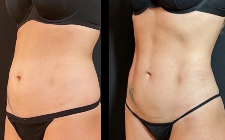 Is Fat Transfer in Dubai the Right Choice for Your Aesthetic Goals?