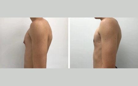 Top Mistakes People Make When Choosing the Best Gynecomastia Surgeon in Dubai