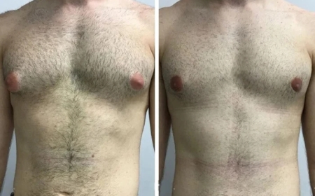 How Long Is Recovery? Timelines Explained by the Best Gynecomastia Surgeon in Dubai