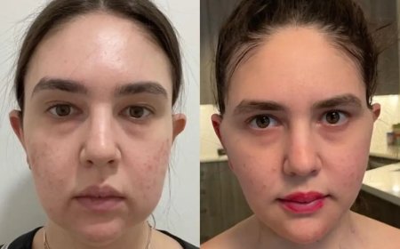 How Safe Is Buccal fat removal in Dubai?