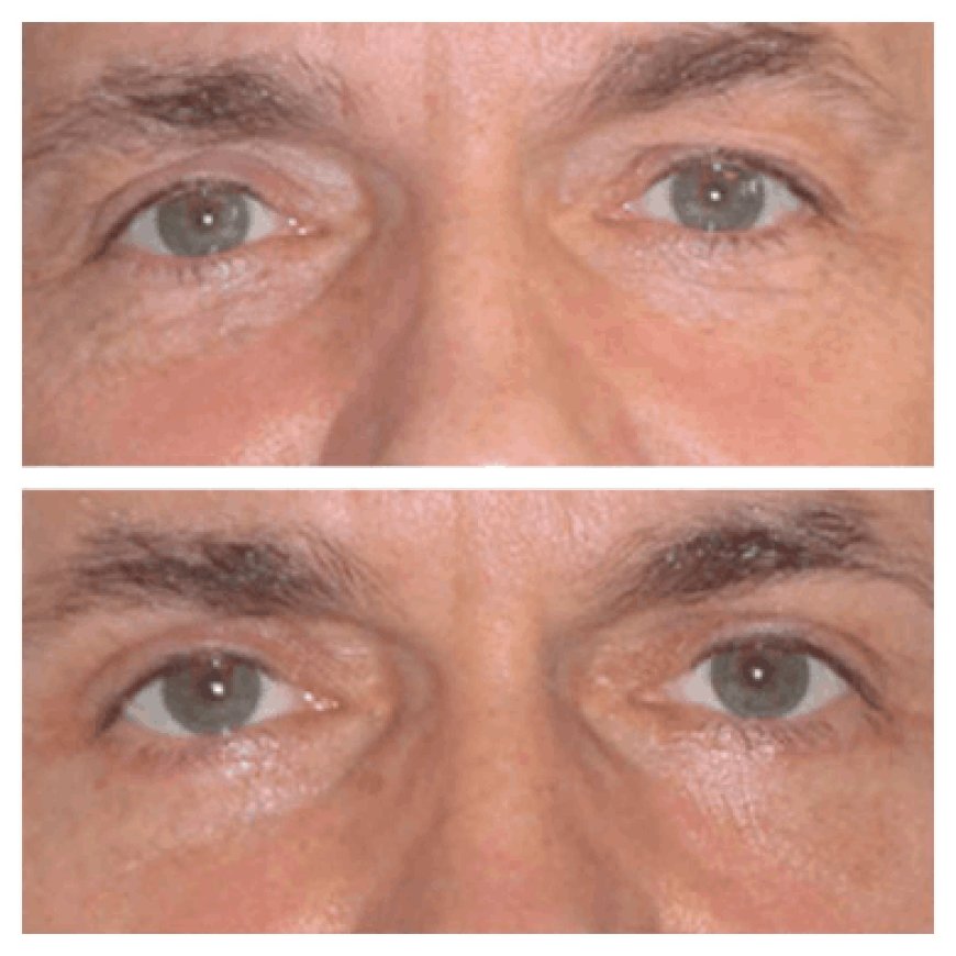 Eye bag removal in Dubai: What’s the recovery process?